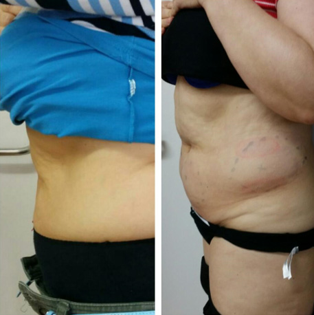 coolsculpting-fat-freezing/cryolipolysis