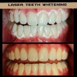 Laser Teeth Whitening Course