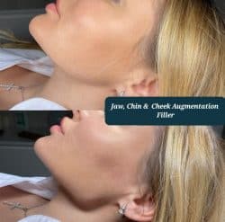 Chin, Jaw, Cheeks Augmentation