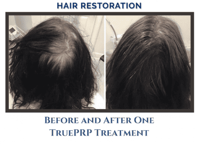 PRP Hair Regrowth