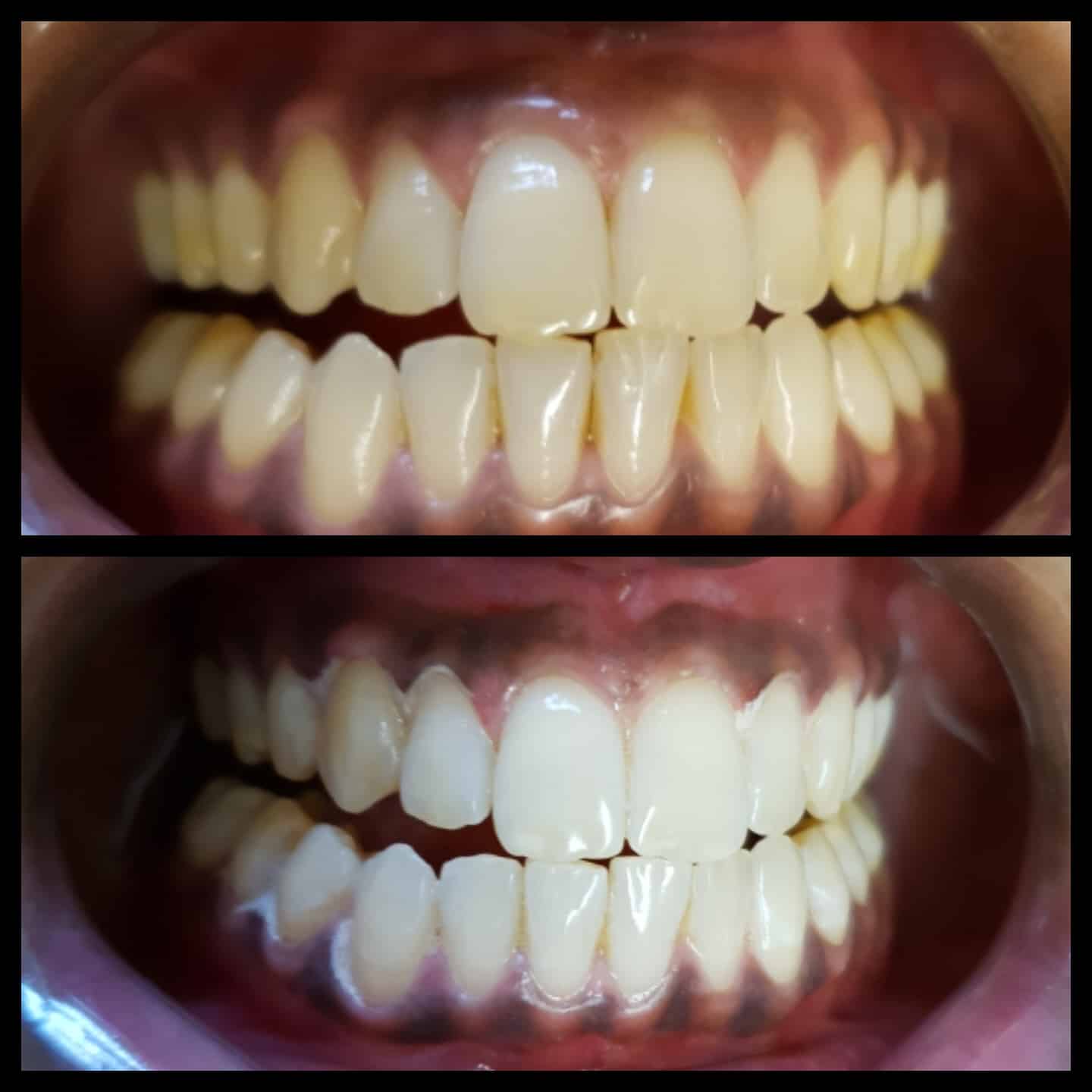 How Safe And Effective Is Laser Teeth Whitening? Belle Clinic London