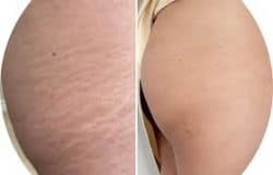 Scar Camoflauge & Stretch Marks Removal