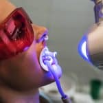 laser-teeth-whitening