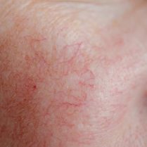 spider-veins-removal
